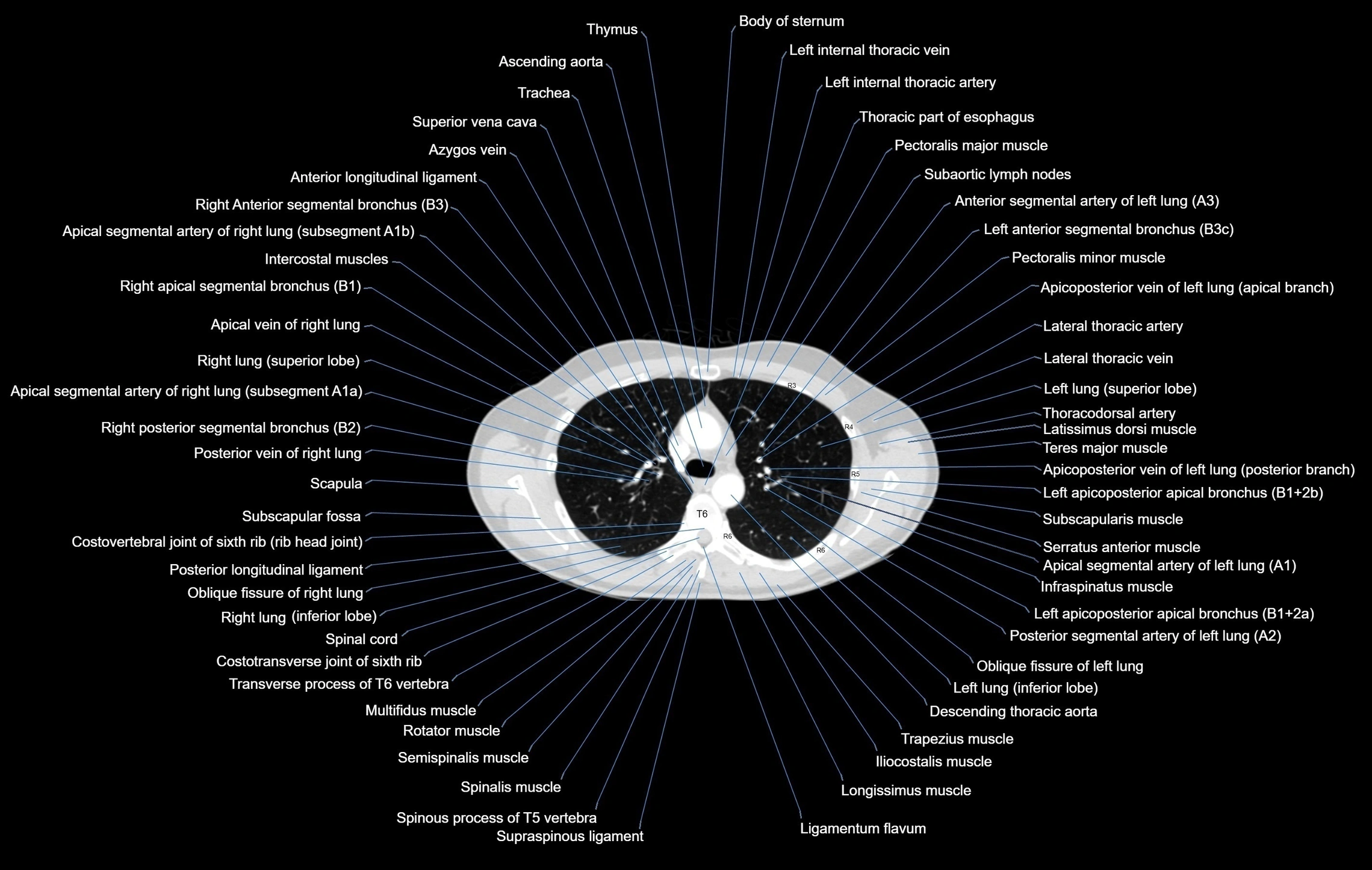 CT chest (thorax) lung window window labelled axial cross sectional anatomy radiology image-00043.webp